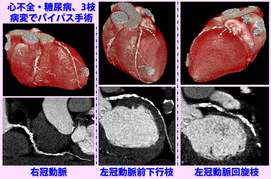 虚血性心不全の冠動脈