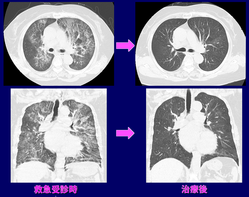 急性心不全肺水腫