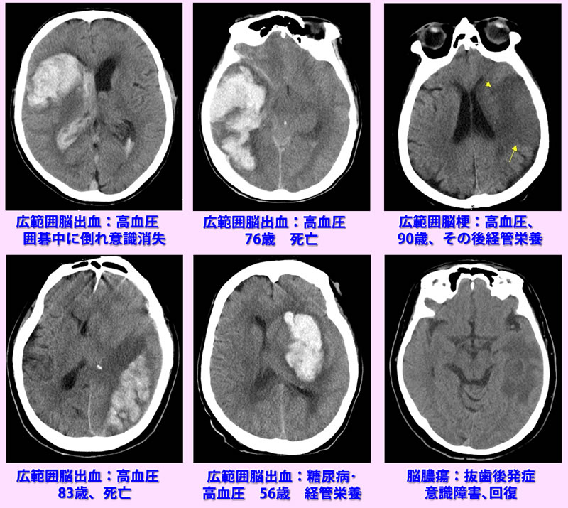 意識障害のCT画像