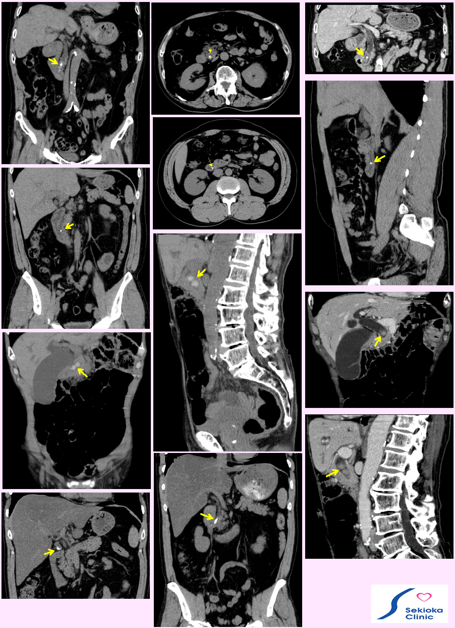 胆管炎・胆管結石