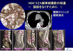 MDCTとX線撮影の相違