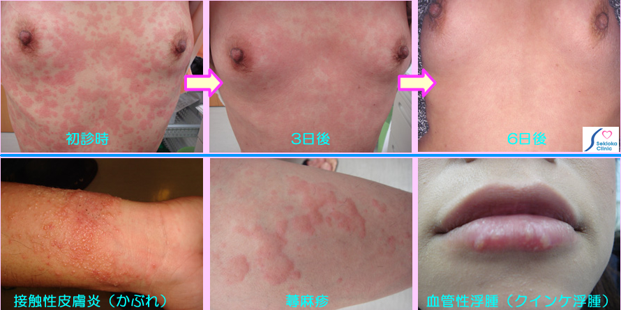 皮膚アレルギー　写真