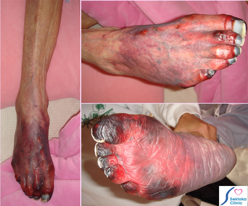 進行した循環不全・壊死