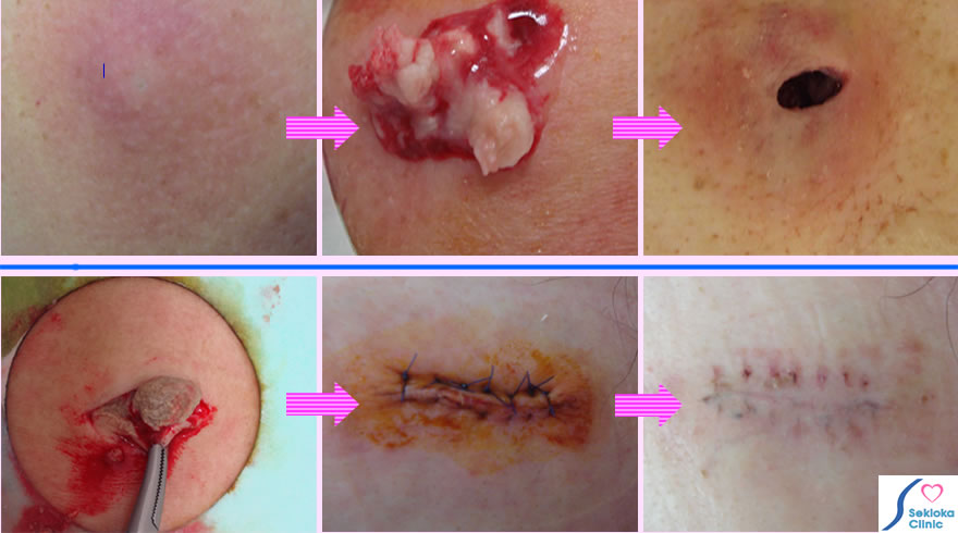 粉瘤、アテローム