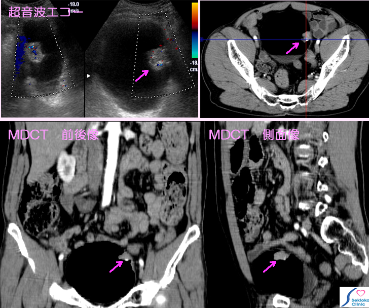 膀胱がん診断画像