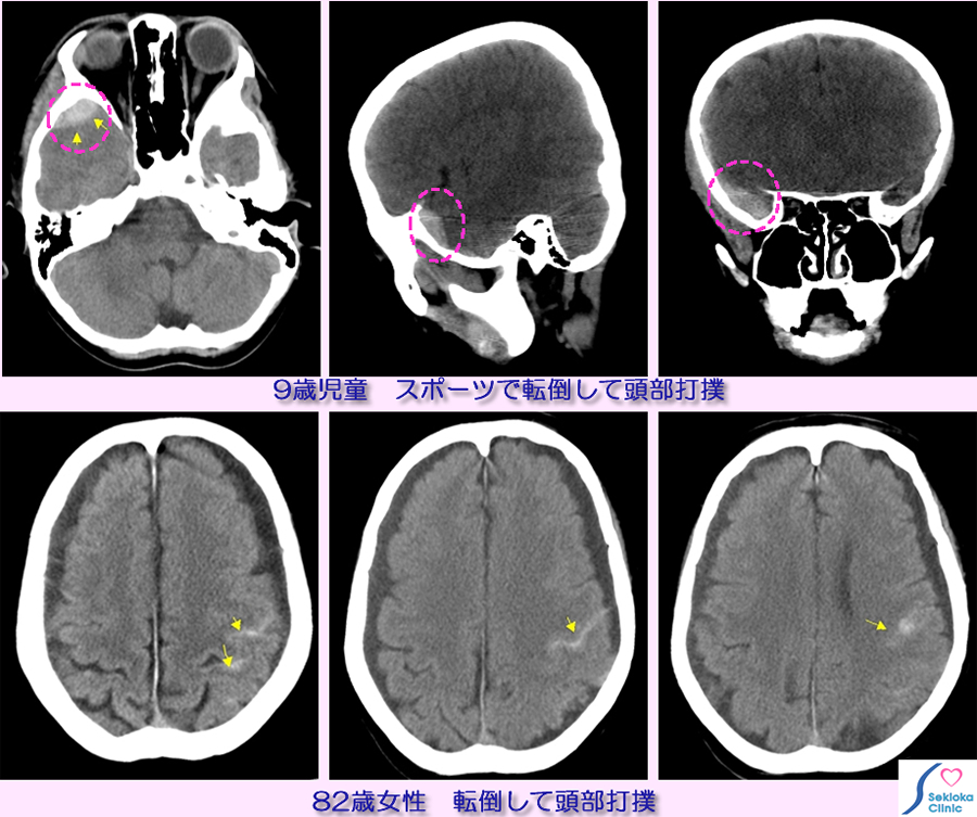 頭部外傷　頭蓋内出血