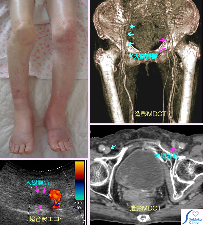 静脈血栓症　診断画像