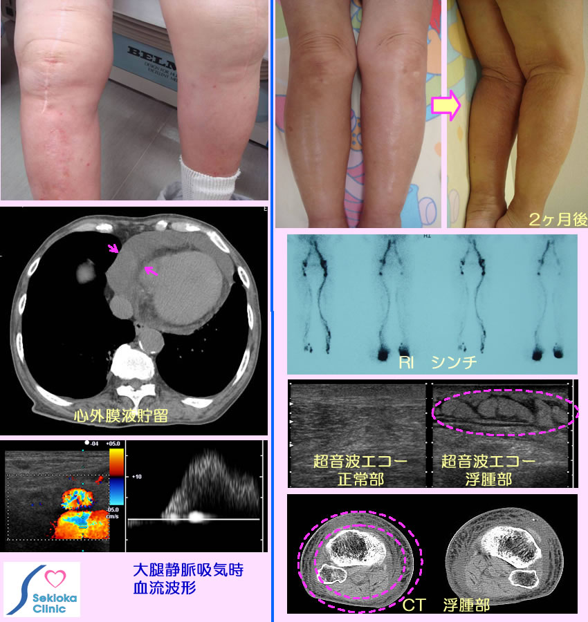 浮腫の原因　比較画像