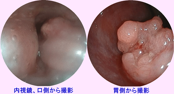 食道癌下部内視鏡