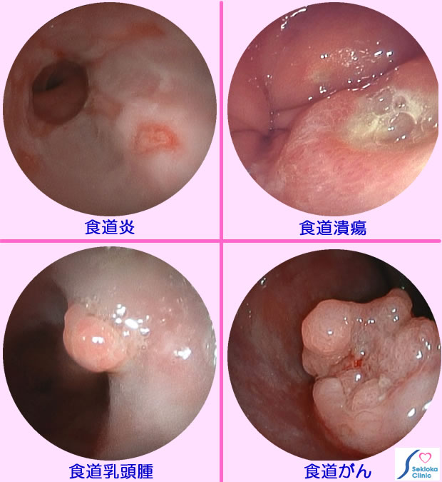 食道の病気　内視鏡