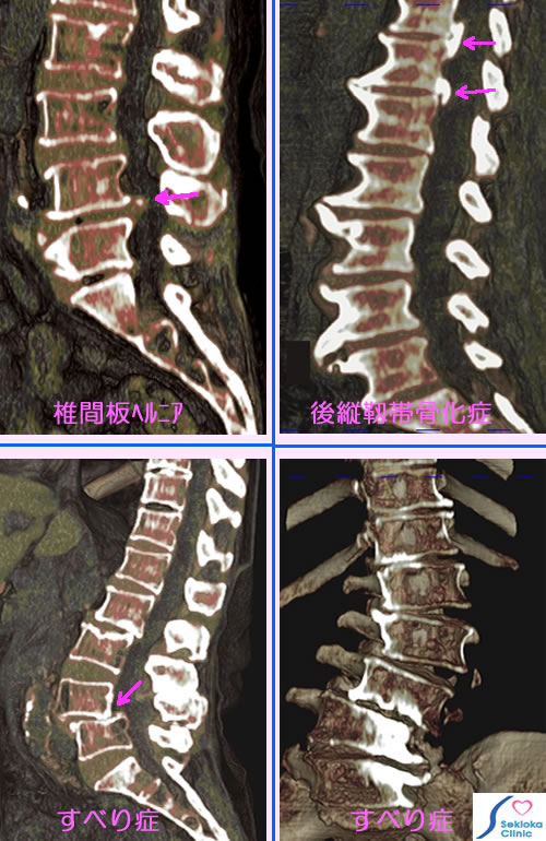 腰椎の病気　症状と診断