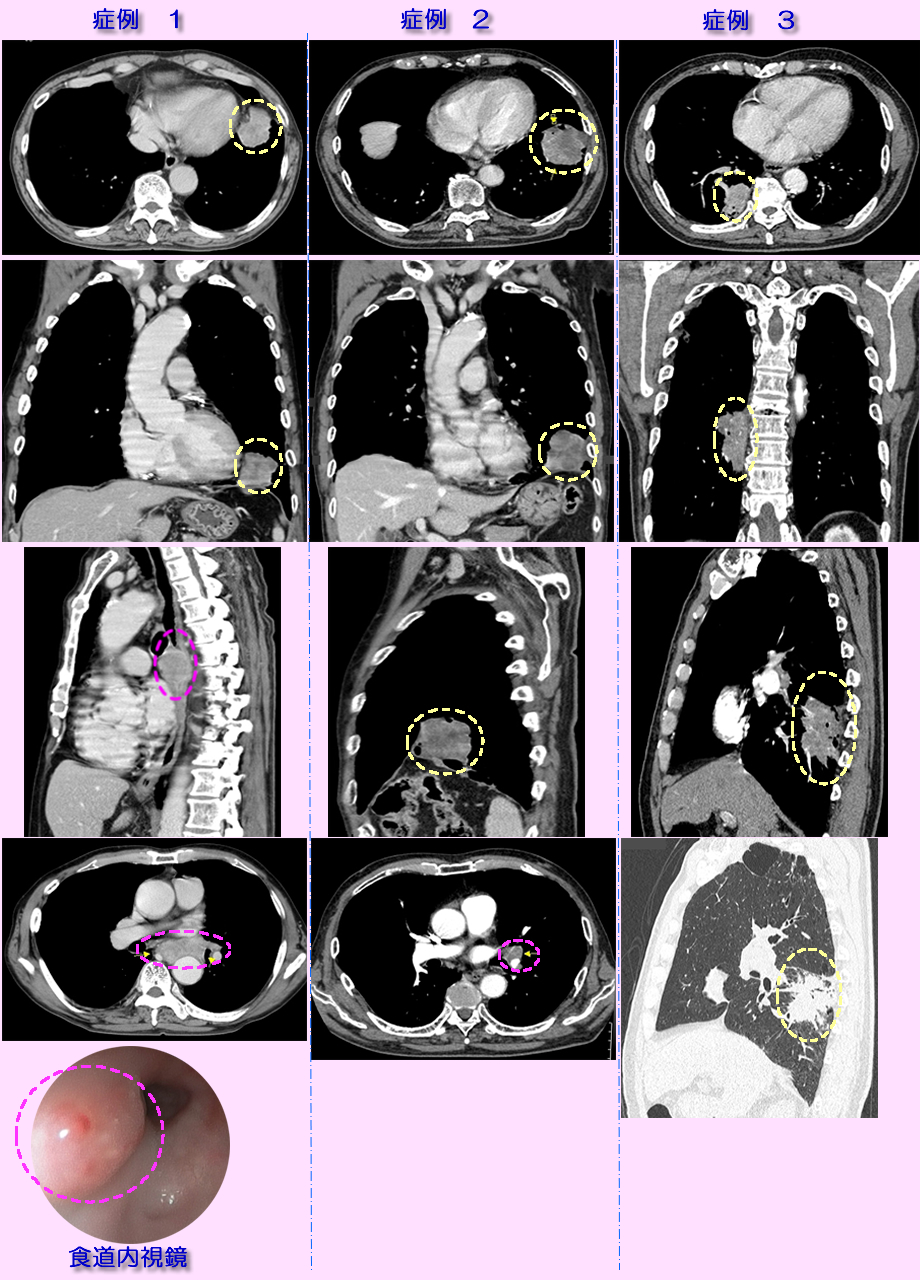 肺がん・進行がん