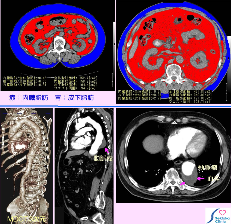 メタボリックシンドローム　内臓脂肪　診断画像