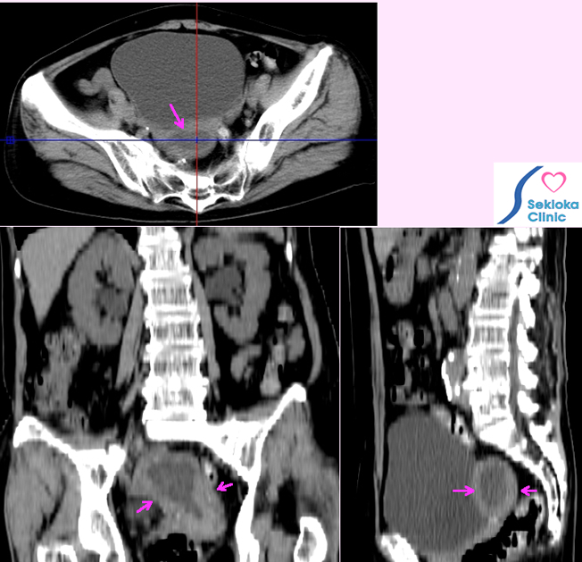 子宮体部癌画像