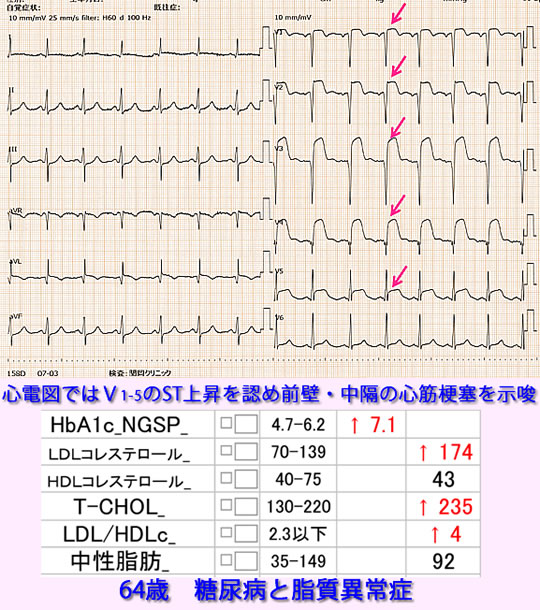 急性心筋梗塞心電図