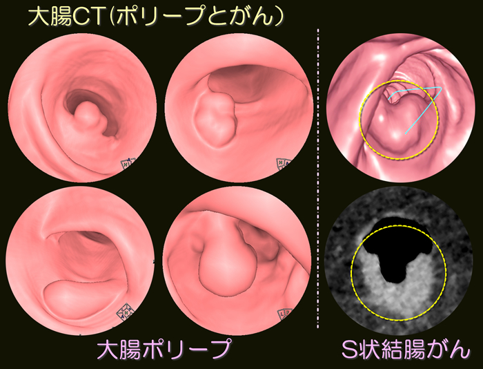 大腸ポリープとがん